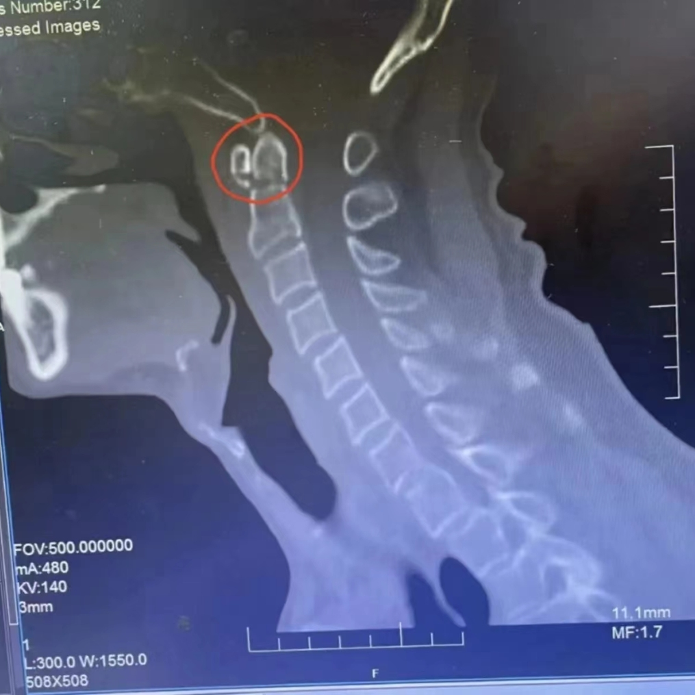 枢椎骨折可致高位截瘫!4颗螺钉稳稳守护