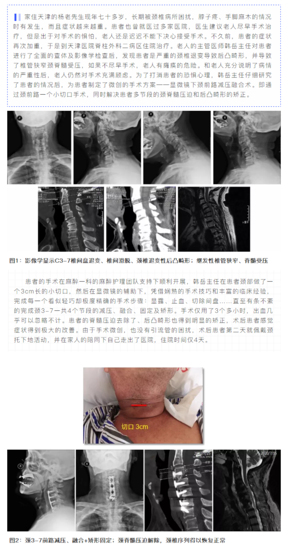 脊柱外科二病区微创手术成功治愈脊髓型颈椎病合并颈椎后凸畸形患者