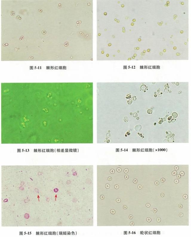 尿红细胞形态图片