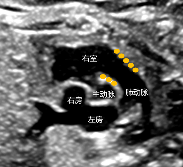 动脉圆锥在哪里?有什么用?