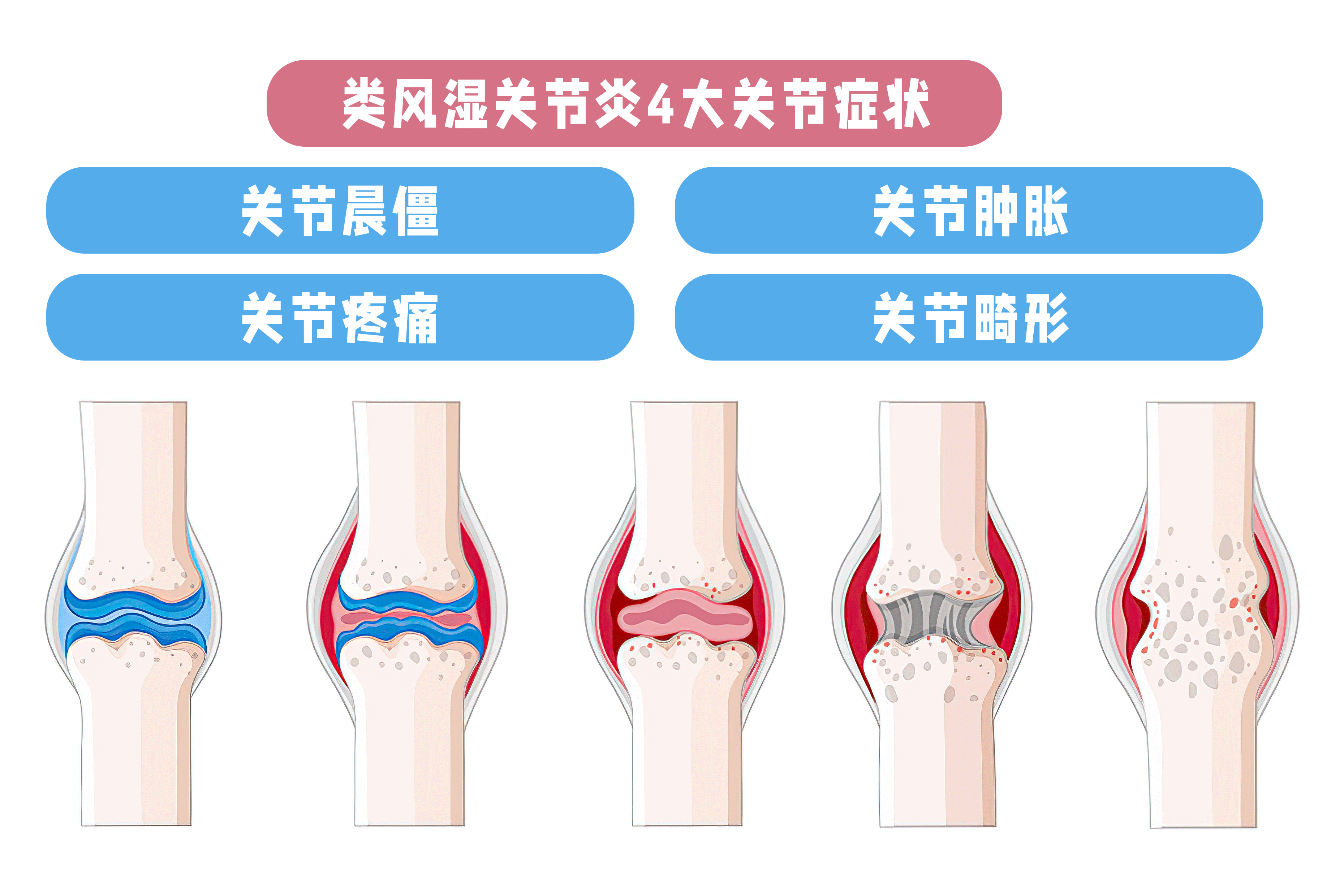 类风湿图片大全展示图片