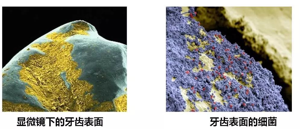 蛀牙要怎么治疗?