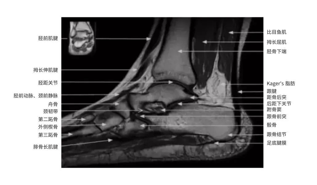 踝关节核磁解剖图图片