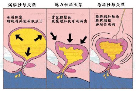 如何判断自己的尿失禁属于哪种类型?