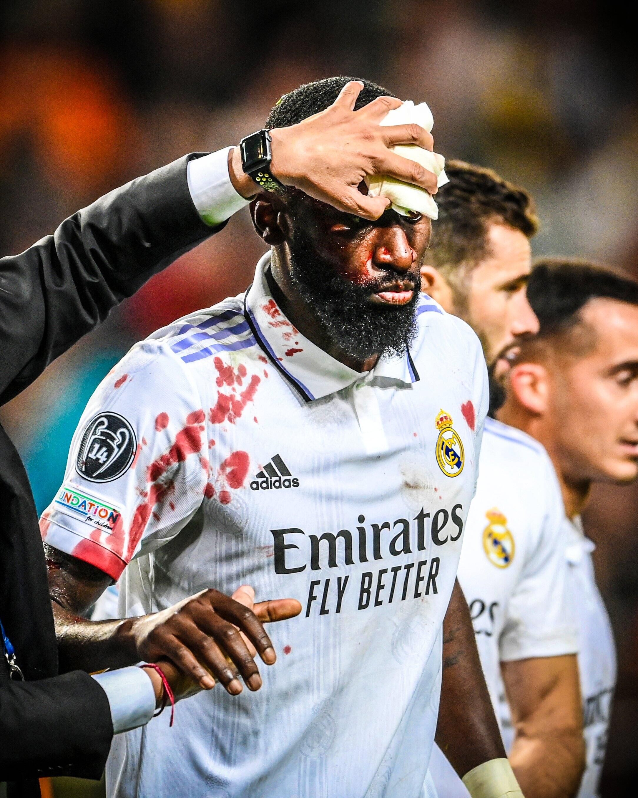 世体:皇马正给吕迪格设计数款面具,若能睁开右眼他有望出战巴萨