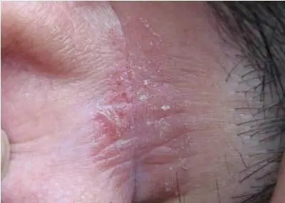 阴囊瘙痒长小痘痘然后溃烂结痂脱皮用什么药好