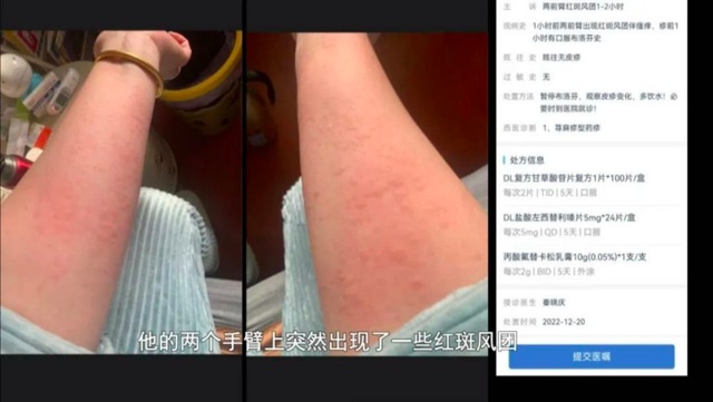 8歲女孩吃布洛芬過敏腫成香腸嘴,爸爸:吃的是兒童版,不知道會過敏