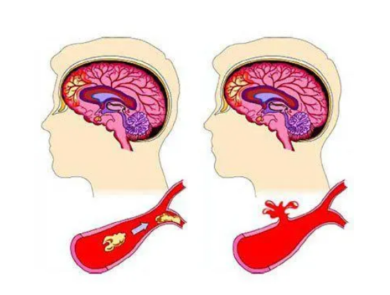 脑梗塞症状(脑梗塞症状有哪些表现)-第1张图片-鲸幼网