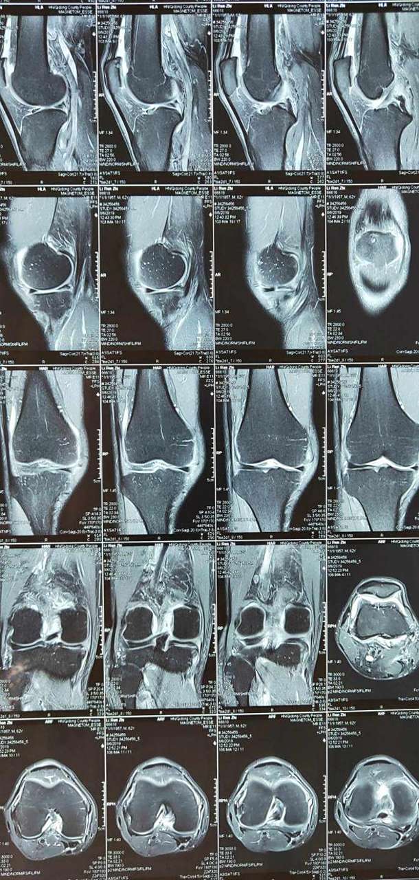 半月板损伤,作为最常见的膝关节损伤之一