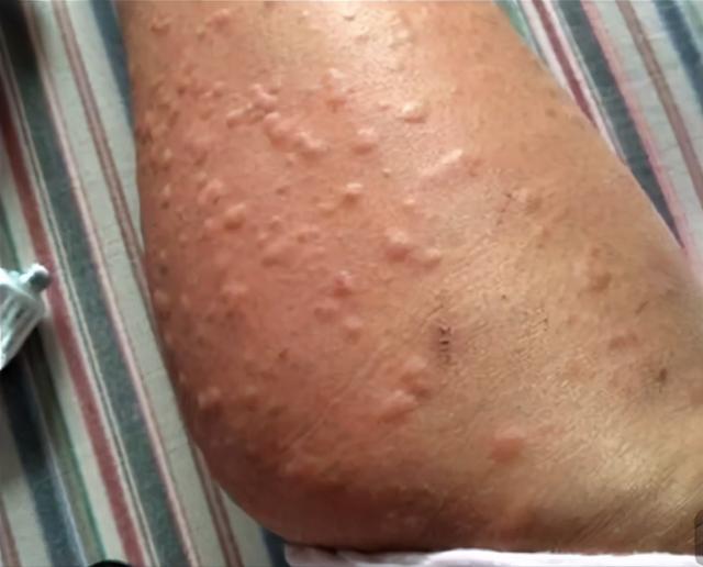 门诊案例|中医治疗慢性荨麻疹,有着独特的优势