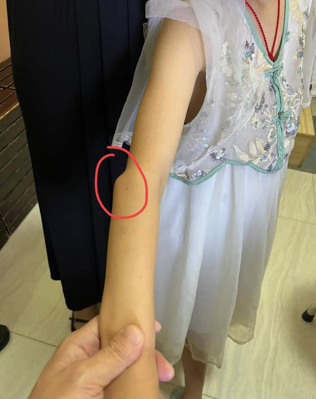 这个4岁女孩,家长发现小孩的肘部后面鼓起了个"包",问她疼不疼,她说没