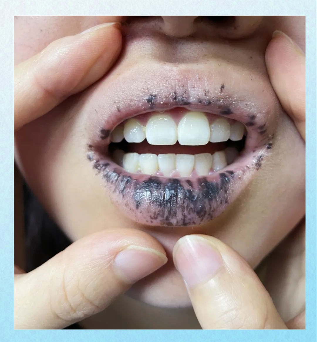 小果向医护人员坦言,自幼时起,她便因口周黑子而深感自卑,甚至不愿