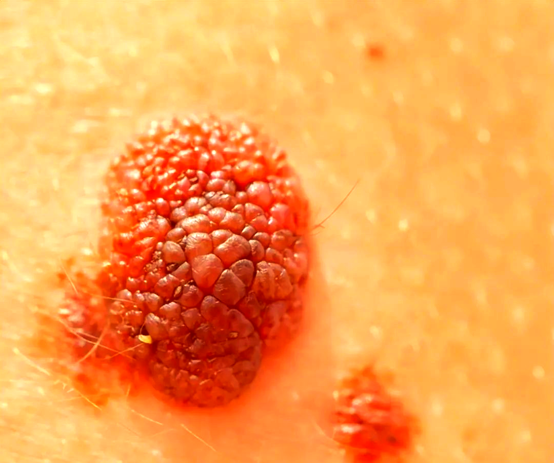 8岁孙子患皮肤癌,奶奶后悔痛哭,医生指责其选购衣物不慎