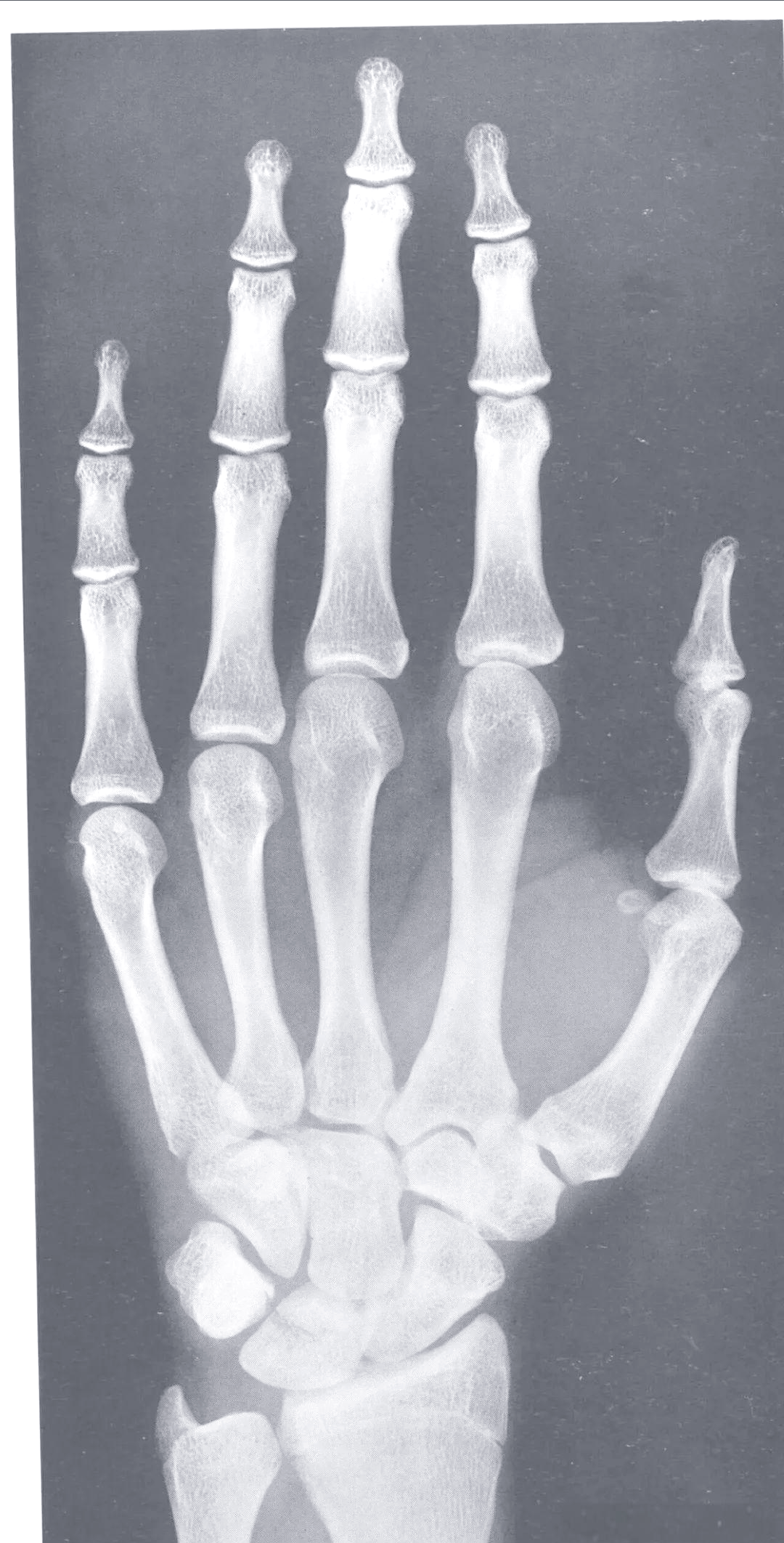 在正常情况下,骨龄与实际年龄之间的差异应控制在±1岁以内,若偏离此