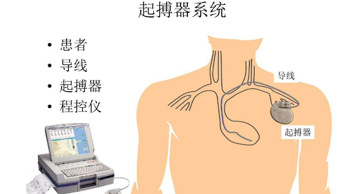 起搏器位置图片图片