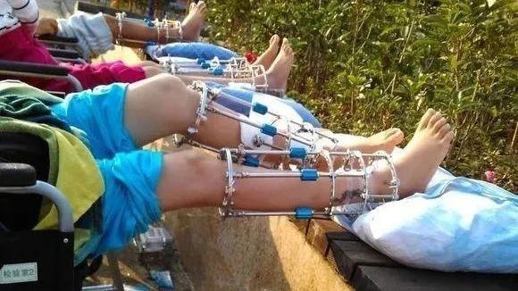 断骨增高,这项被国家明文禁止的"增高术",很多人还在做