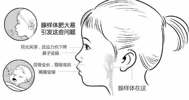 孩子腺樣體肥大,應該保守治療還是手術?