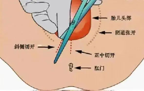 顺产撕裂恢复图图片