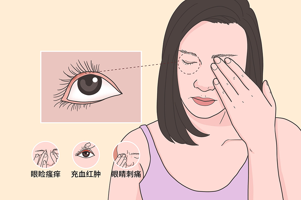 哪些方法可以预防麦粒肿?如何预防不长针眼