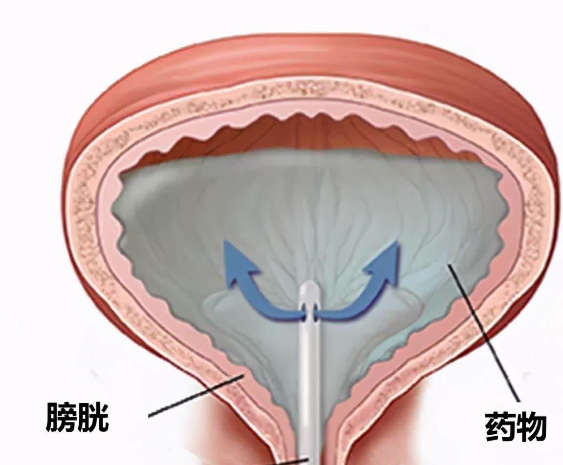 膀胱原位癌图片