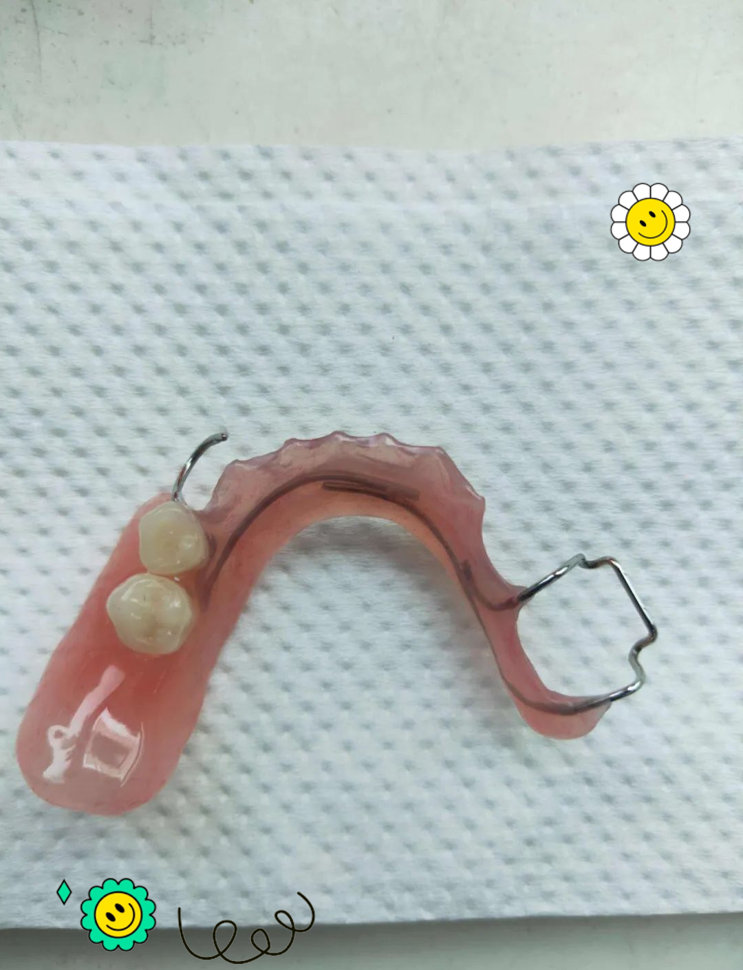 间隙保持器:维持牙齿间隙的良方