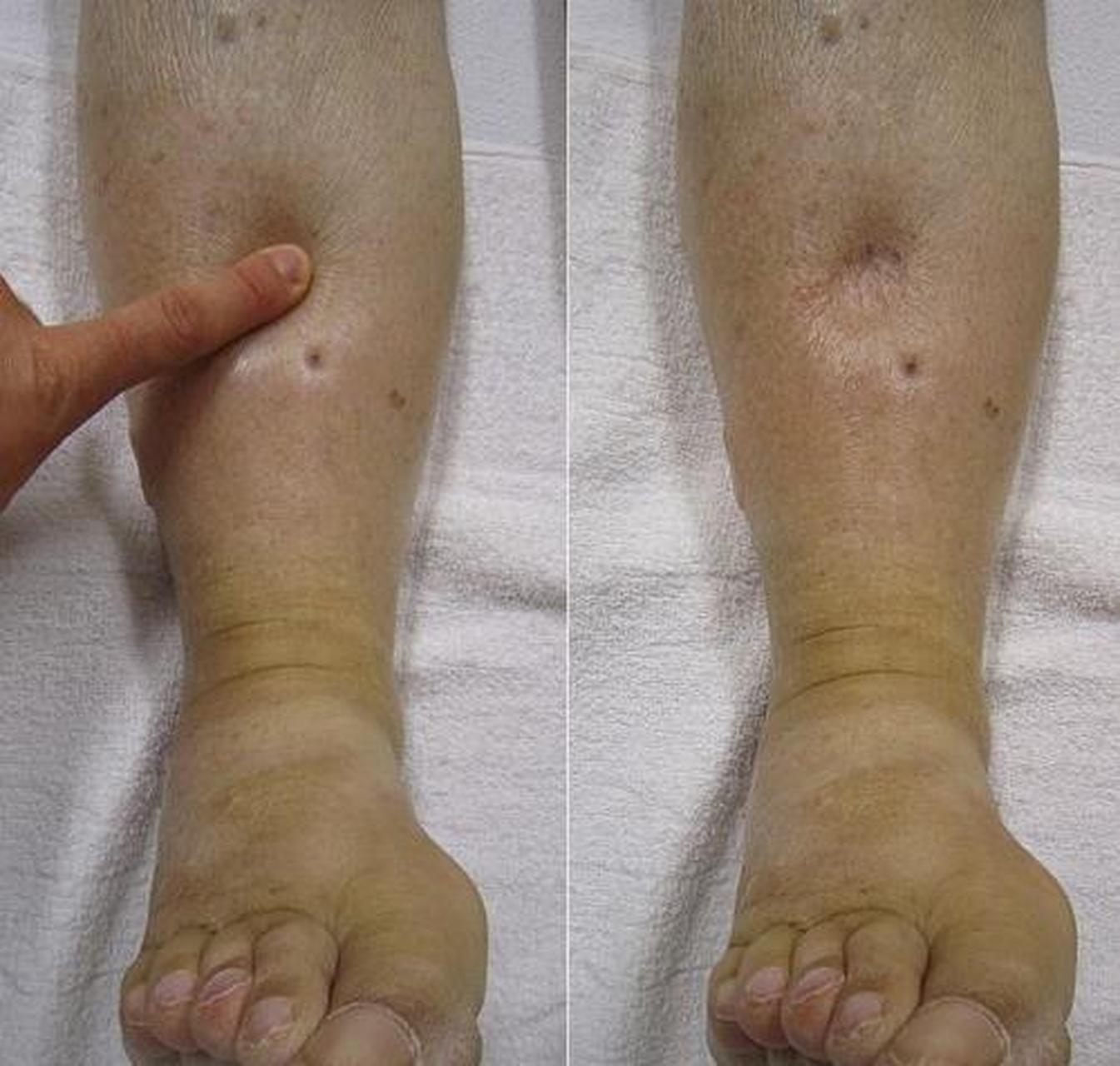 "糖肾"——糖尿病最危险的并发症之一,早期症状有哪些?