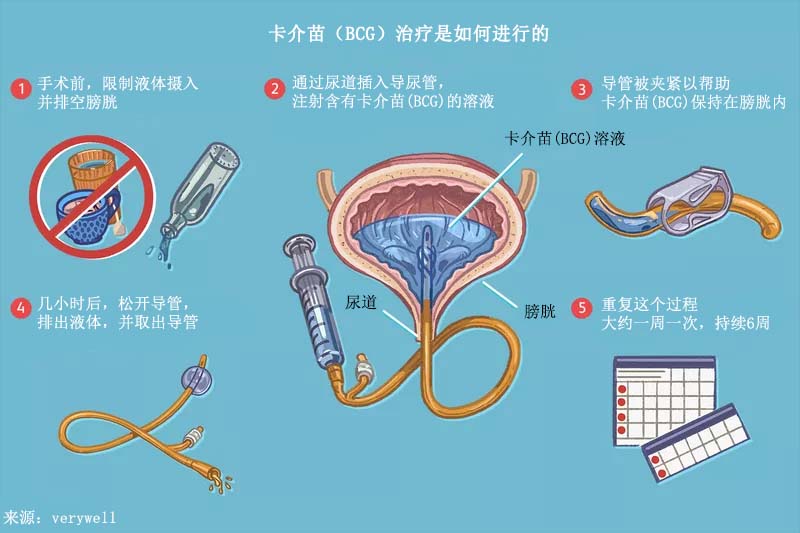 免疫治疗卡介苗(bcg)对非肌肉浸润性膀胱癌的治疗作用