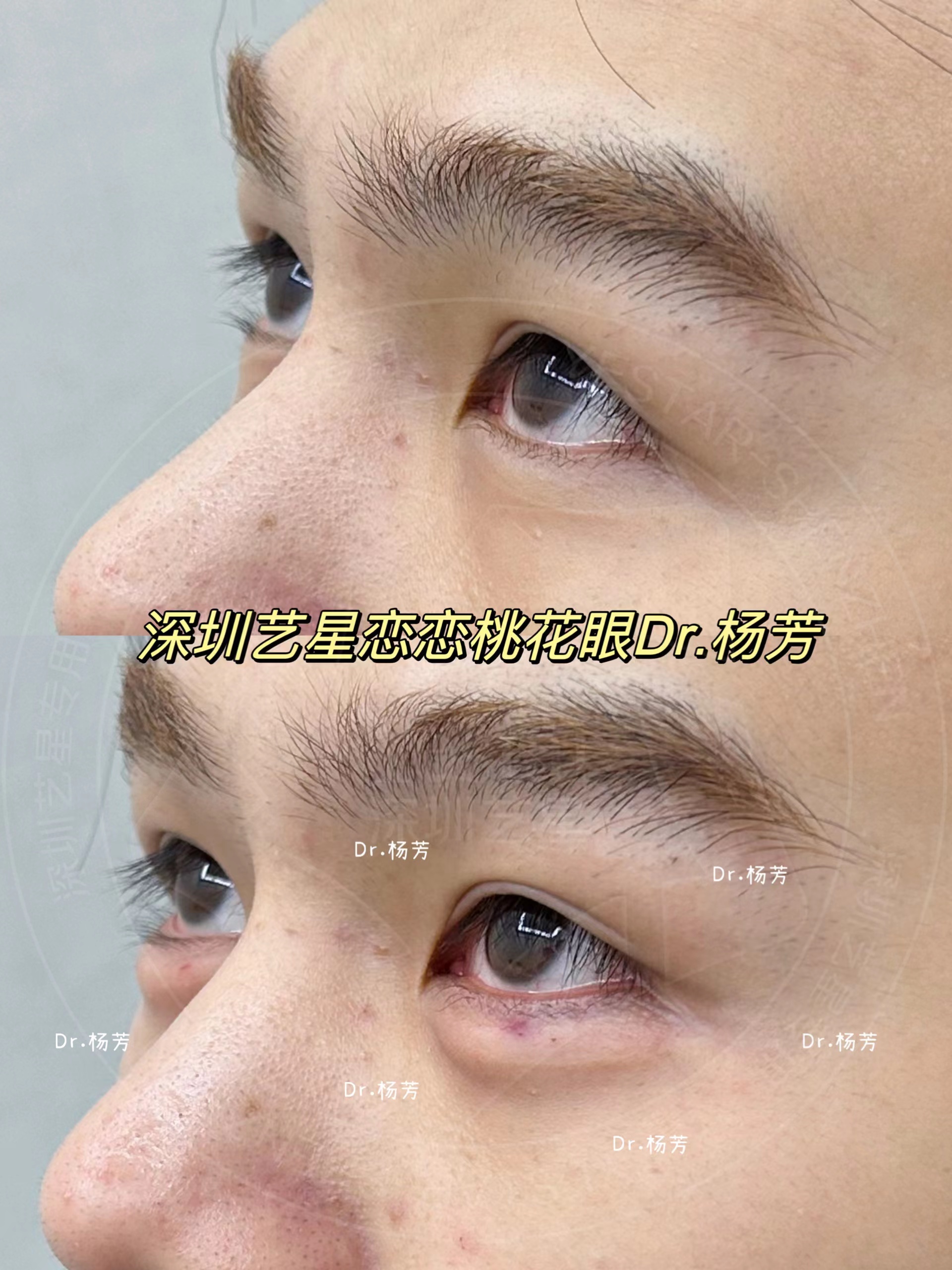 案例分享|深圳艺星 杨芳主任 男士卧蚕注射