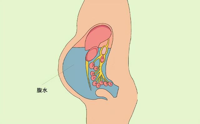 卵巢癌腹水图片