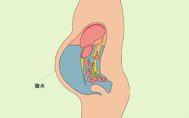 卵巢癌晚期出現腹水是一件很麻煩的事,為什麼這麼說呢?