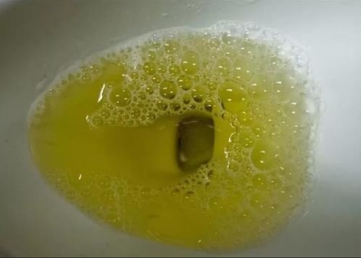 尿液偏黄是什么问题图片