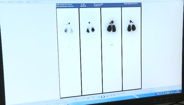碘131治疗,会不会影响身体其他器官?