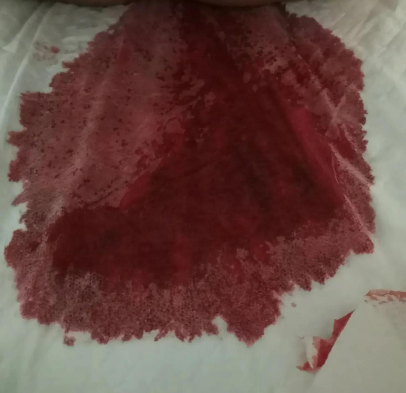 "不好了,大夫,20床出血了,可多,您赶紧去看看吧"