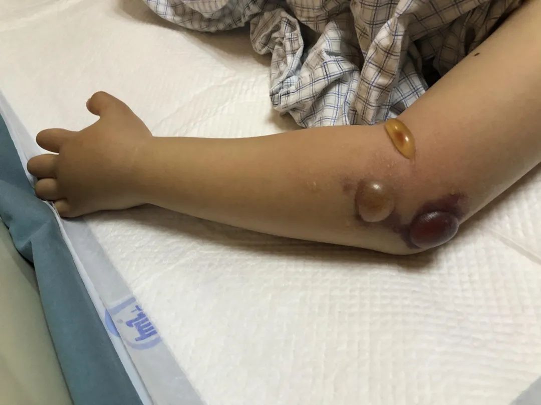 童说健康 |张力性水泡能直接戳破吗?