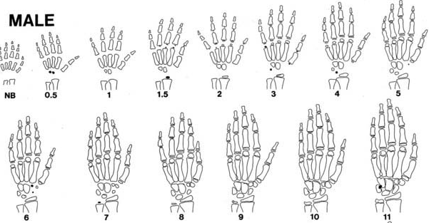 孩子出现这些情况真的有必要测骨龄