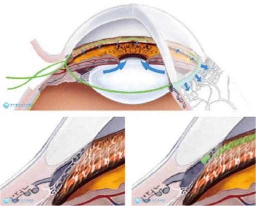 微创青光眼手术——360°小梁扩张/切开术