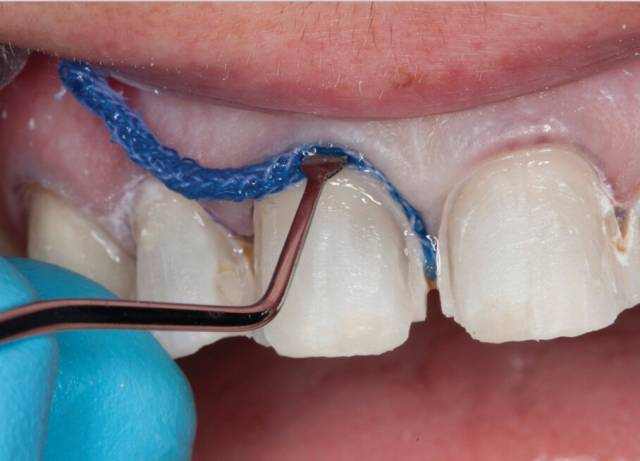 排龈线在牙科修复中的应用与注意事项解析