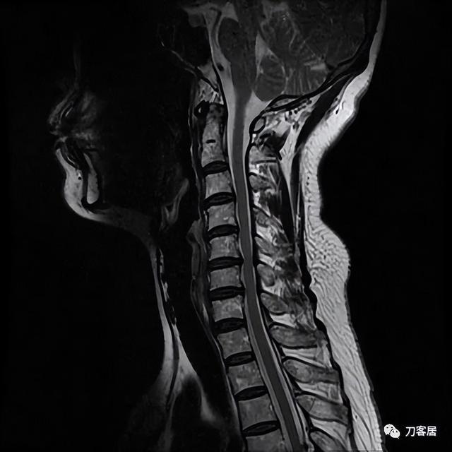 脊髓型颈椎病图片高清图片