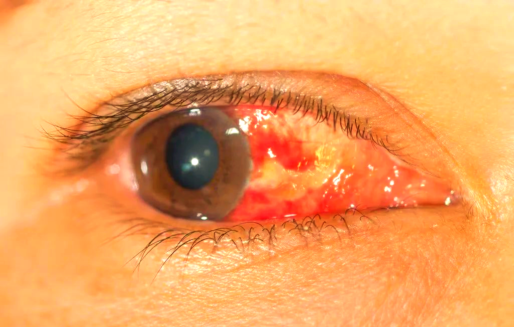 眼健康小贴士:眼底出血与眼表出血的区别及注意事项