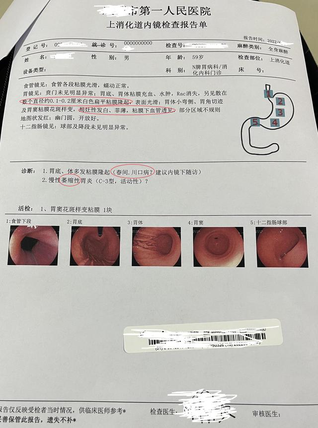 萎缩性胃炎c1