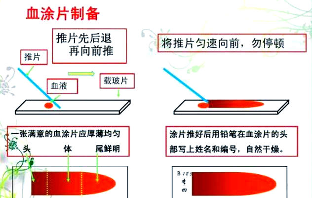 血涂片制备与应用详解:手工与仪器法全面解析