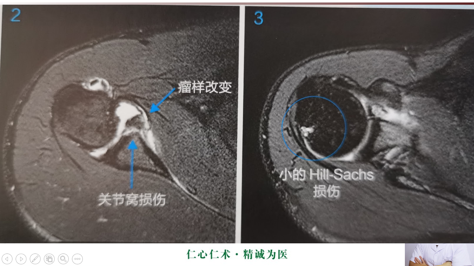 盂肱韧带mri解剖图片