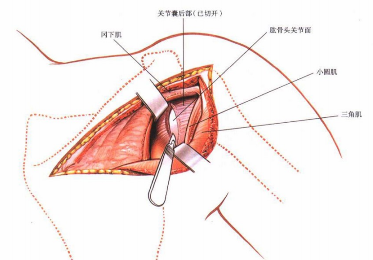 肩关节入路图解图片