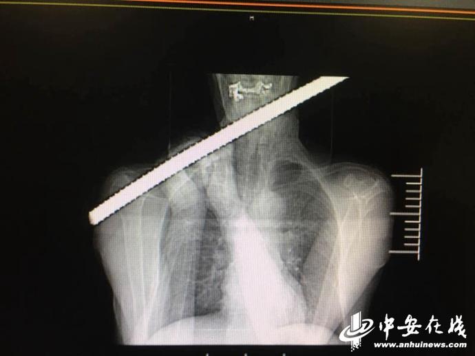 惊险!肥东一务工师傅被1米多长钢筋贯通颈部