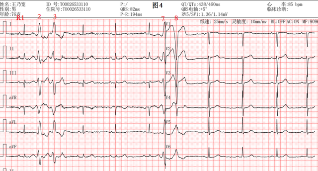 室性早搏三联律心电图图片