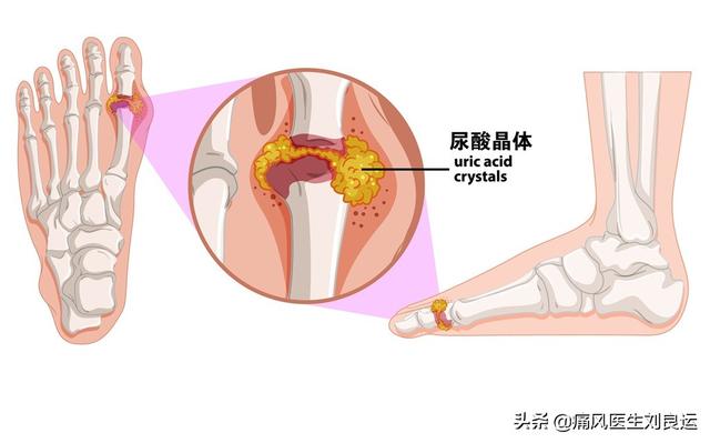 痛風的發生主要與尿酸鹽結晶沉積在關節有關,常見於第一蹠趾關節