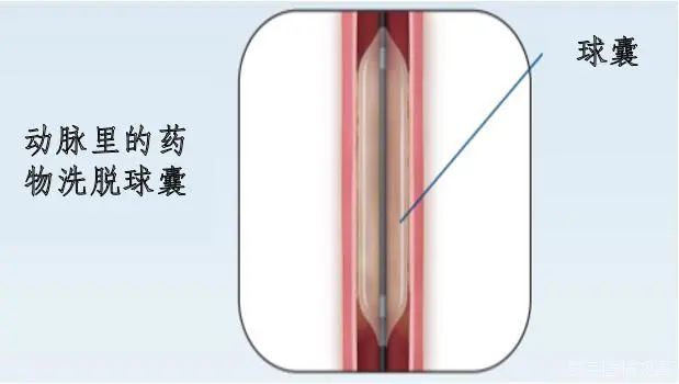 行业丨fda批准上市——波士顿科学ranger 紫杉醇药物洗脱球囊介绍