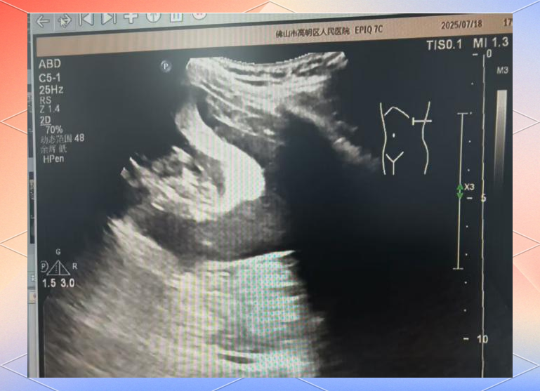 超声介入:脾囊肿治疗的微创新选择