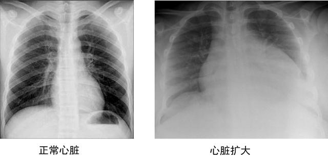 "心大"也是病!心脏扩大的几种常见原因及诊疗策略