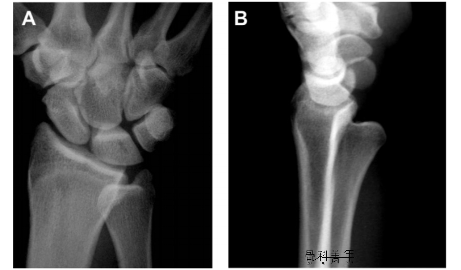 下尺桡关节脱位